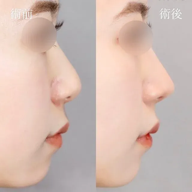 TCB Nasal Tip Plasty_after
