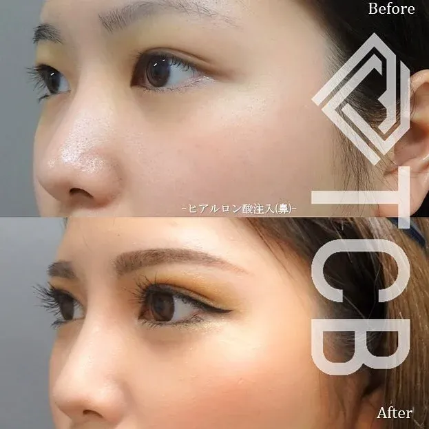 Nose Filler (Hyaluronic Acid Injection)_before