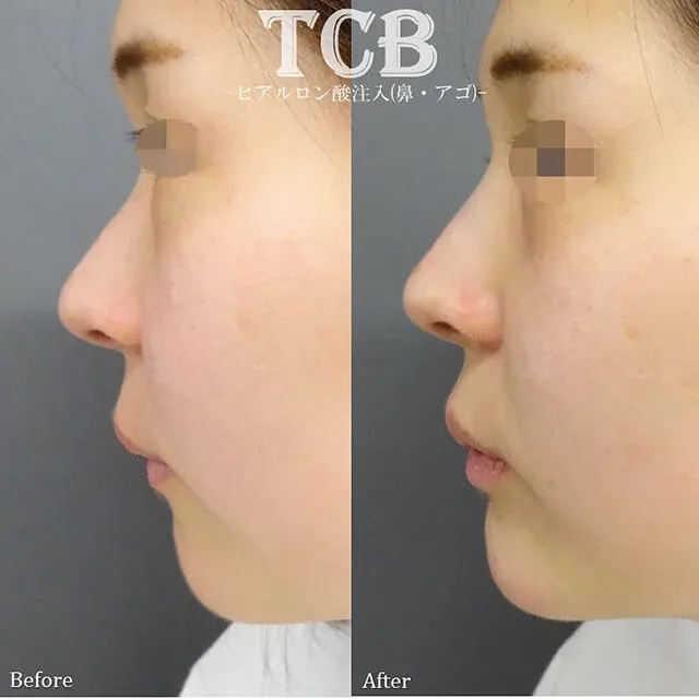 Nose Filler (Hyaluronic Acid Injection)_after