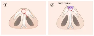 Surgical Method Illustrations