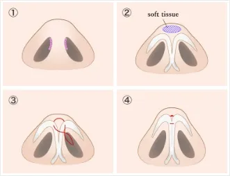 Surgical Method Illustrations