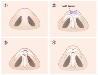 Surgical Method Illustrations