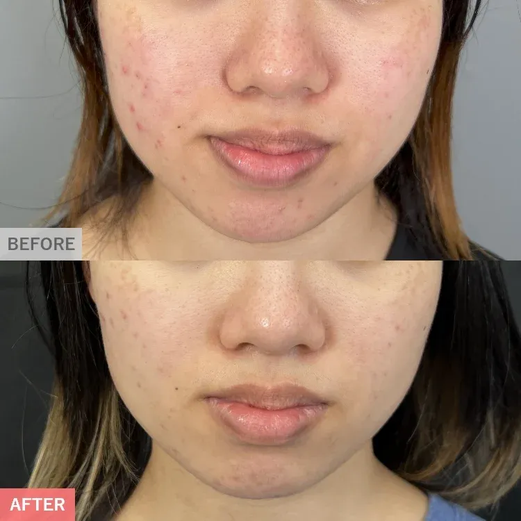 Pico Fractional