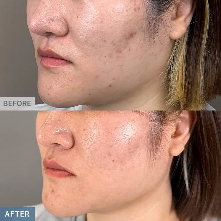 Dermapen 4