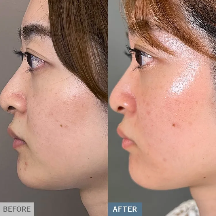 Dermapen 4