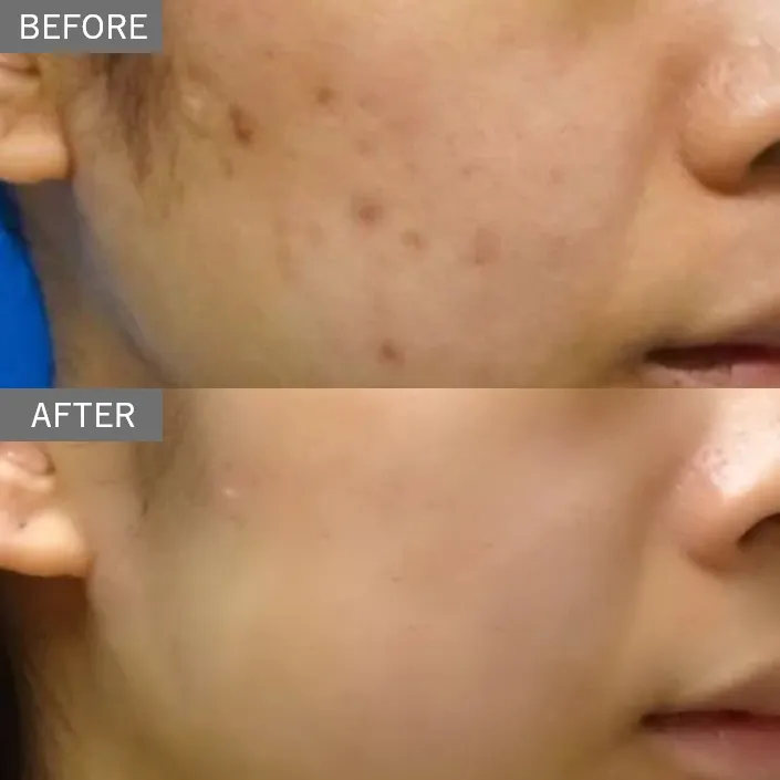 Subcision (Acne Scar Treatment)
