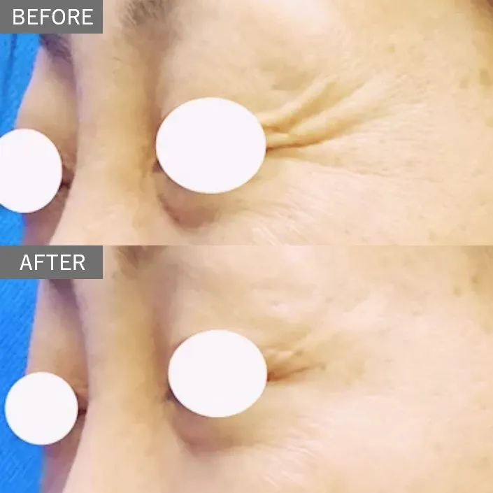 Wrinkle Regeneration Injection (Sunekos Injection)