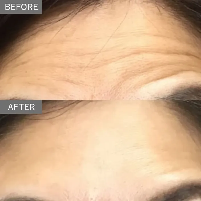 Wrinkle Regeneration Injection (Sunekos Injection)