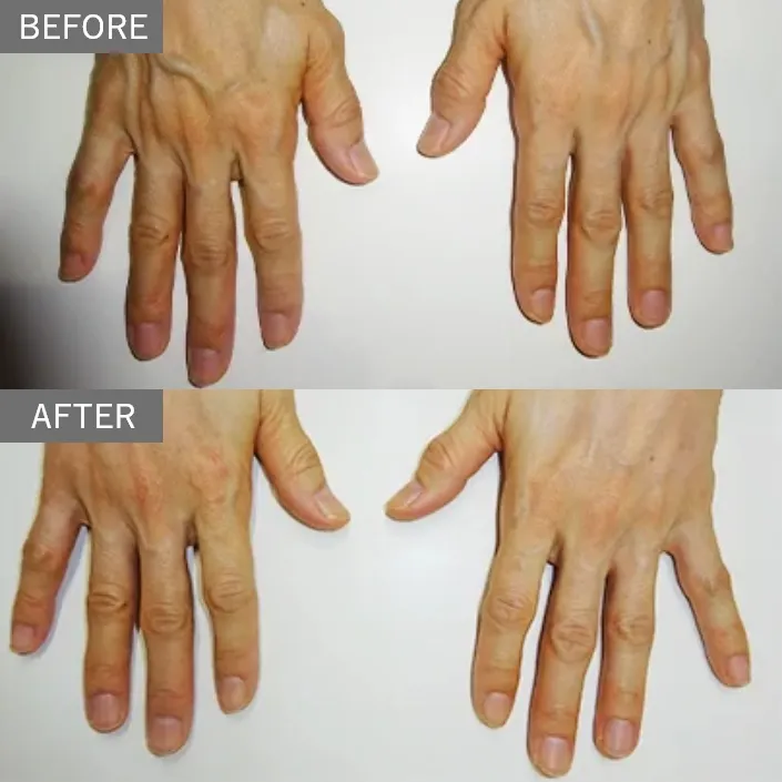 Hand Vein Treatment
