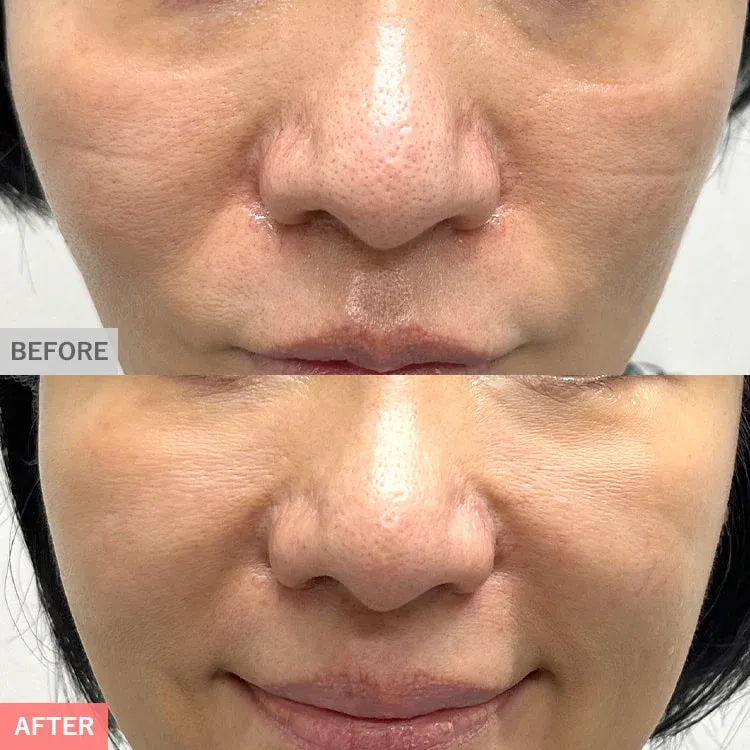 Fibroblast Therapy (Skin Regenerative Treatment)