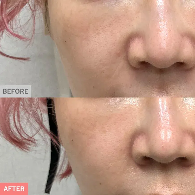Fibroblast Therapy (Skin Regenerative Treatment)