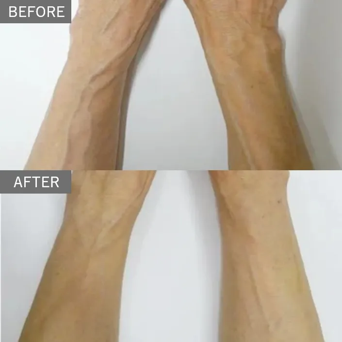 Hand Vein Treatment
