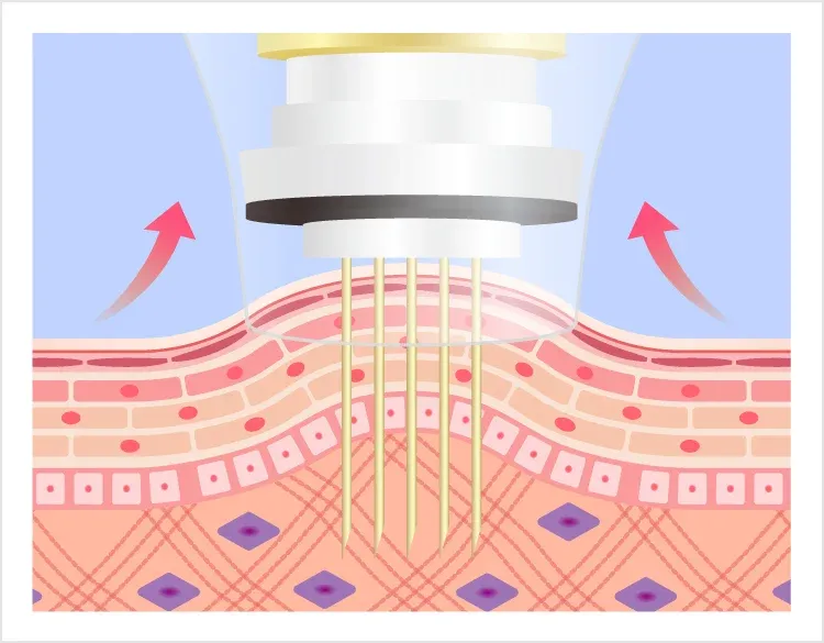 Therma Needle (FRM)