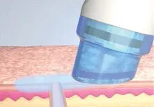 HydraFacial