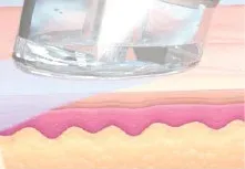 HydraFacial