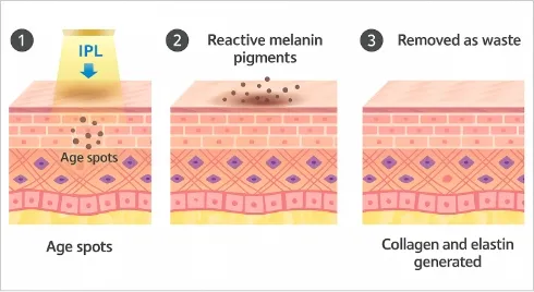 IPL Photofacial Treatment Case Photo