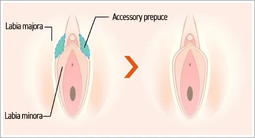 Accessory Labia (Accessory Fold) Excision