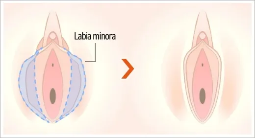Labiaplasty (Labia Minora Reduction)