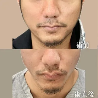 症例写真 TCB小顔リフト 画像01