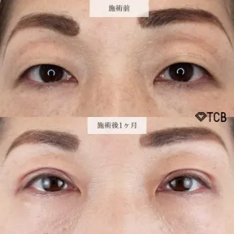症例写真 二重切開法 画像11