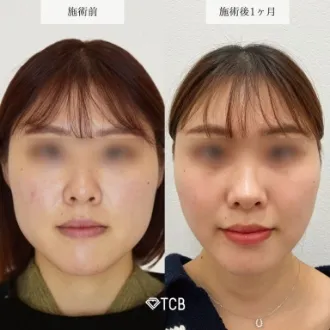 症例写真 エラのボトックス小顔注射 画像10