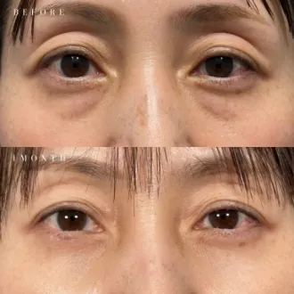 症例写真 切らない目の下のクマ・たるみ取り 画像02