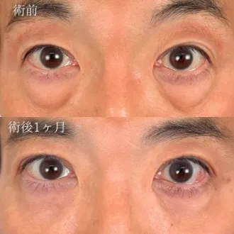 症例写真 切らない目の下のクマ・たるみ取り 画像03