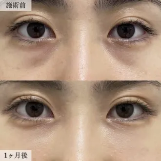 症例写真 切らない目の下のクマ・たるみ取り 画像06