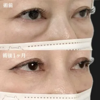 症例写真 切らない目の下のクマ・たるみ取り 画像08