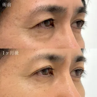 症例写真 切らない目の下のクマ・たるみ取り 画像09