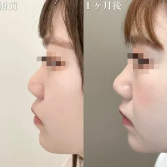 症例写真 TCBメッシュ 画像01