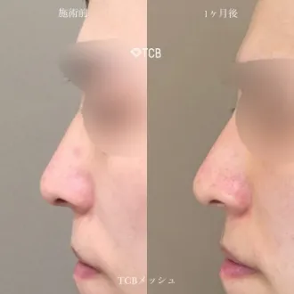 症例写真 TCBメッシュ 画像02