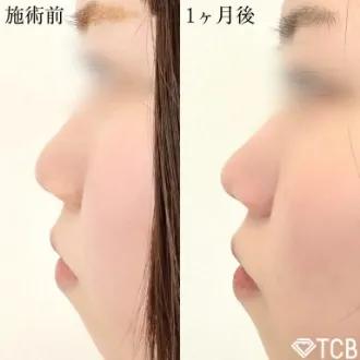 症例写真 鼻尖形成完全閉鎖法(切らない鼻尖形成) 画像04