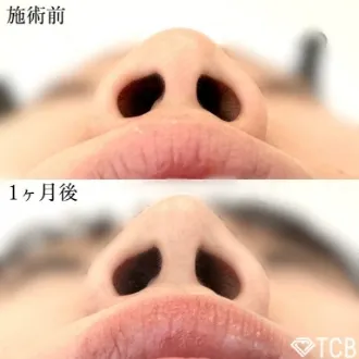 症例写真 鼻尖形成完全閉鎖法(切らない鼻尖形成) 画像05