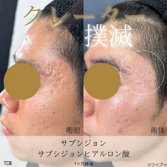 症例写真 サブシジョン（クレーター治療） 画像01