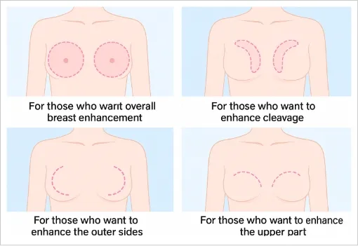 Achieve Your Ideal Bust with High-Design Fat Injection