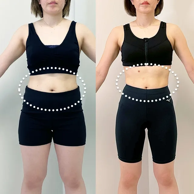 Beauty Slim Program（美体瘦身计划）案例照片