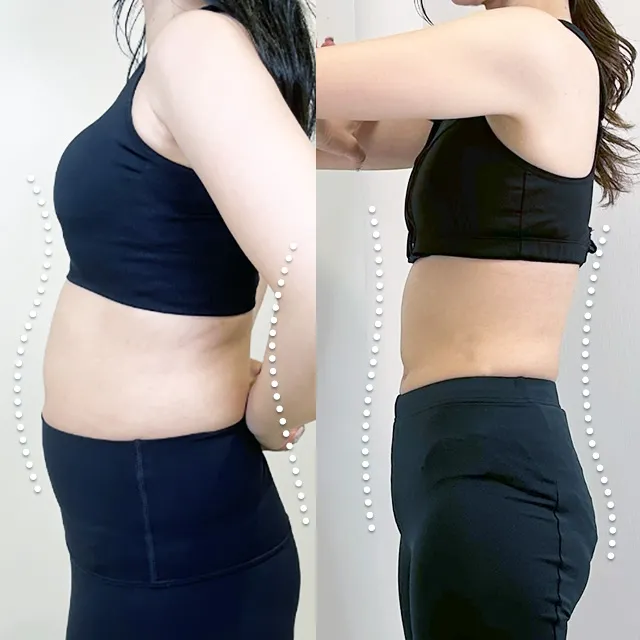 Beauty Slim Program（美体瘦身计划）案例照片