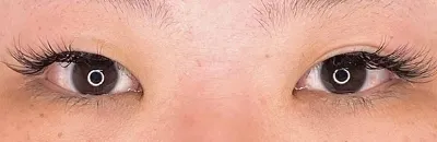 双眼皮切开术_before