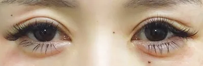 开外眼角手术_before