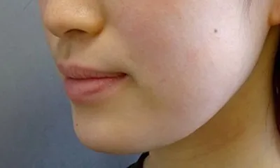 医疗HIFU（高强度聚焦超声）_before
