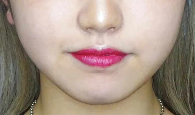 医疗HIFU（高强度聚焦超声）_before