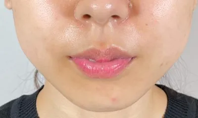 颊脂垫去除术（Buccal Fat Removal）_before