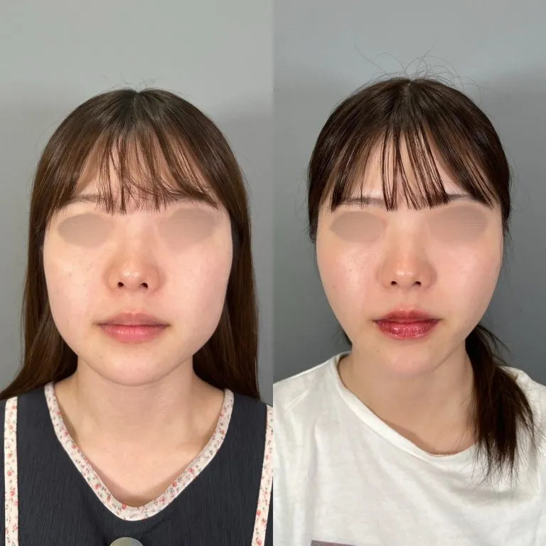 TCB小脸埋线提升案例照片