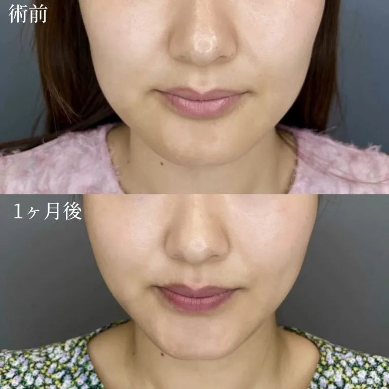 医美HIFU超声刀
