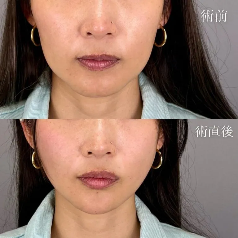 小脸美肌再生线雕提升术