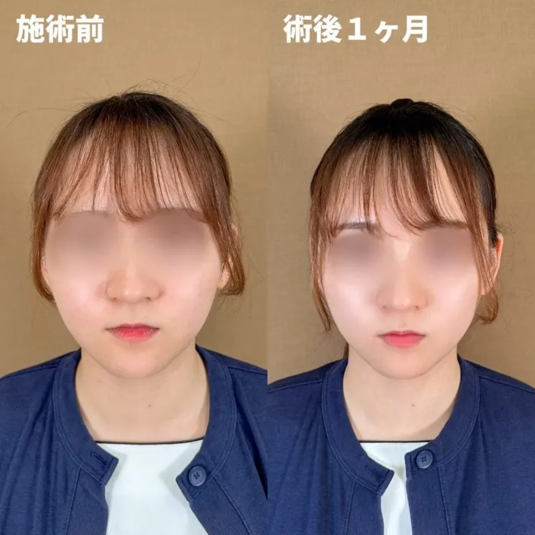 Clear Fine 埋线提升术