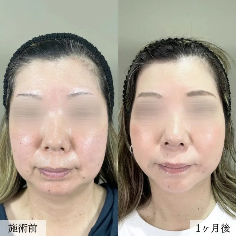 下颌缘脂肪去除术