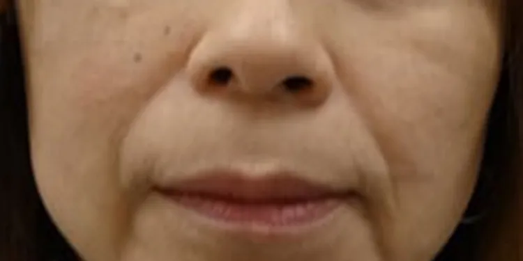 法令纹玻尿酸注射_before