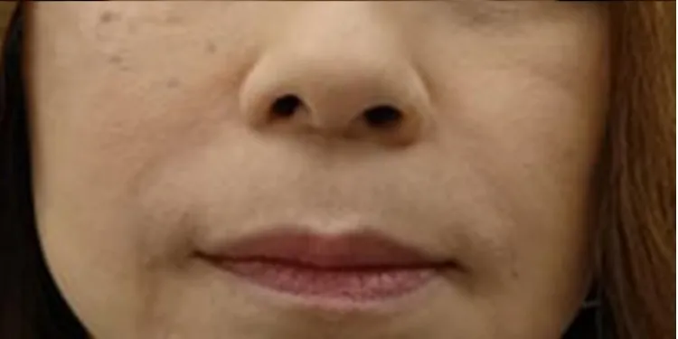 法令纹玻尿酸注射_after
